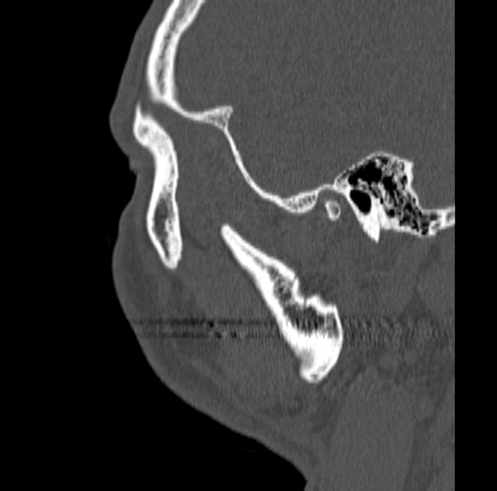 Ameloblastoma (Radiopaedia 77750-89997 Sagittal bone window 105).jpg