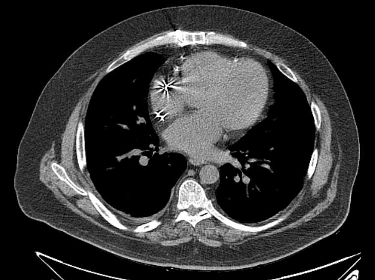 Amiodarone lung (Radiopaedia 62514-70769 Axial non-contrast 53).jpg