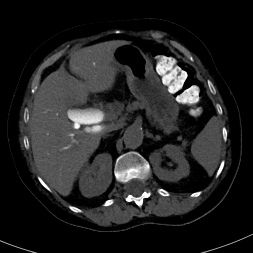 File:Ampullary adenocarcinoma (Radiopaedia 34013-35241 AXIAL THICK 24).png
