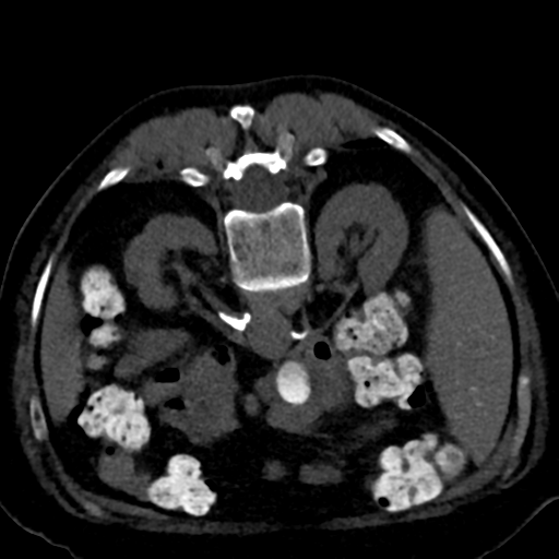 Ampullary adenocarcinoma (Radiopaedia 34013-35241 C 42).png