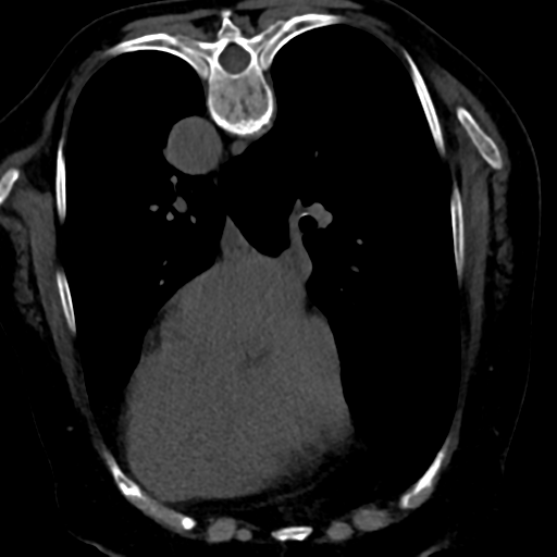 Ampullary adenocarcinoma (Radiopaedia 34013-35241 C 7).png