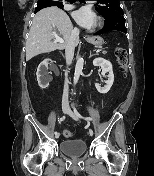 Ampullary adenocarcinoma (Radiopaedia 59373-66734 D 58).jpg