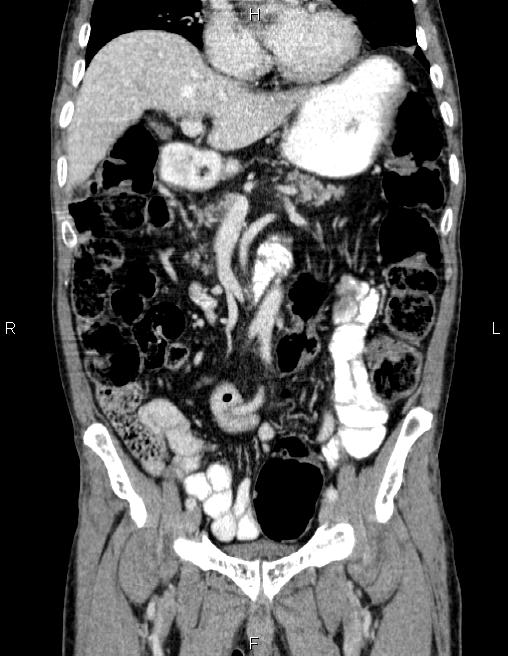 Ampullary adenocarcinoma (Radiopaedia 86093-102032 C 28).jpg