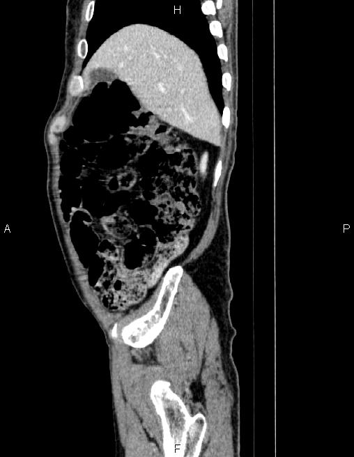 Ampullary adenocarcinoma (Radiopaedia 86093-102032 D 14).jpg