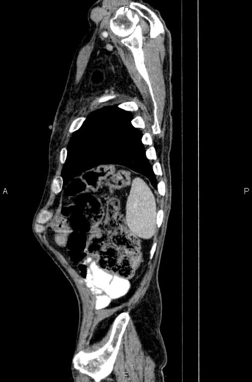 Ampullary adenocarcinoma (Radiopaedia 86093-102033 E 83).jpg