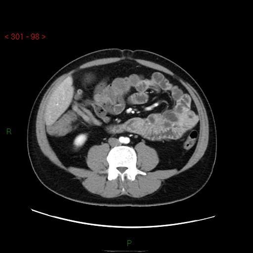 File:Ampullary carcinoma (Radiopaedia 56396-63056 B 44).jpg