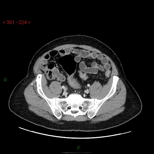 Ampullary carcinoma (Radiopaedia 56396-63056 C 77).jpg