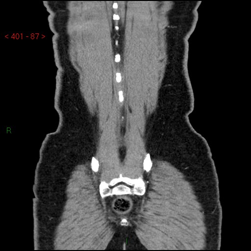 Ampullary carcinoma (Radiopaedia 56396-63056 E 86).jpg