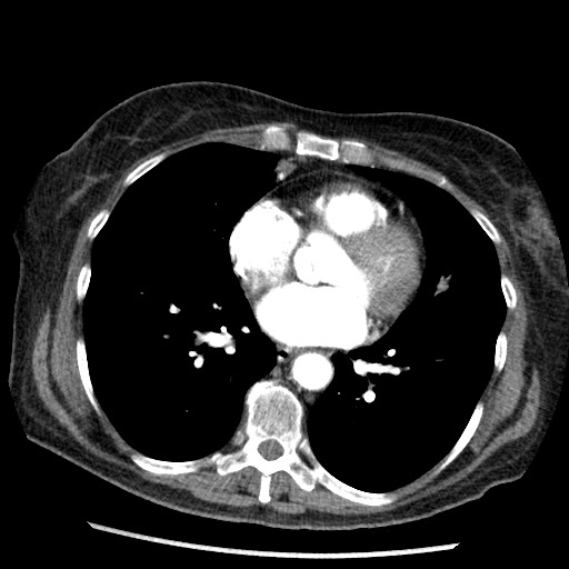 Amyloidosis - bronchial and diffuse nodular pulmonary involvement (Radiopaedia 60156-67745 A 33).jpg