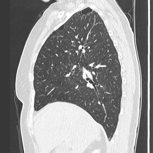 Amyloidosis - bronchial and diffuse nodular pulmonary involvement (Radiopaedia 60156-67745 Sagittal lung window 30).jpg
