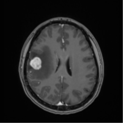 File:Anaplastic astroblastoma (Radiopaedia 55666-62194 Axial T1 C+ 49).png