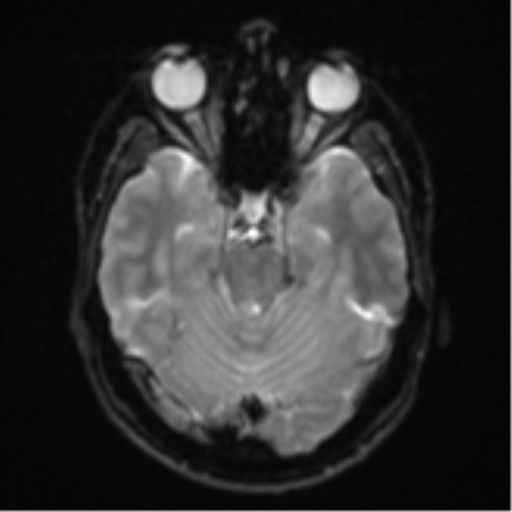 File:Anaplastic astrocytoma (Radiopaedia 57768-64731 Axial DWI 9).png