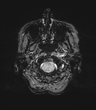 File:Anaplastic astrocytoma (Radiopaedia 86943-103160 Axial SWI 10).png