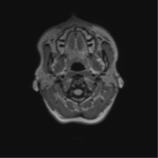 File:Anaplastic astrocytoma IDH mutant (Radiopaedia 50046-55341 Axial FLAIR 1).png