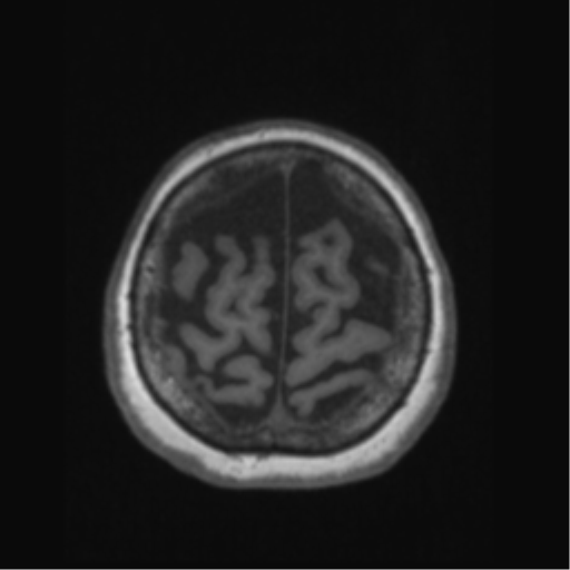 File:Anaplastic astrocytoma IDH wild-type (pseudoprogression) (Radiopaedia 42209-45276 Axial T1 129).png