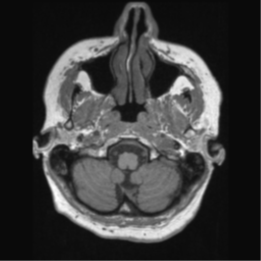 Anaplastic astrocytoma IDH wild-type (pseudoprogression) (Radiopaedia 42209-45276 Axial T1 25).png