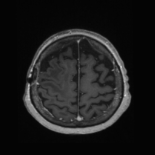 File:Anaplastic astrocytoma IDH wild-type (pseudoprogression) (Radiopaedia 42209-45278 Axial T1 C+ 124).png