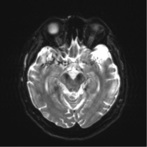 Anaplastic astrocytoma IDH wild-type (pseudoprogression) (Radiopaedia 42209-45279 Axial DWI 11).png