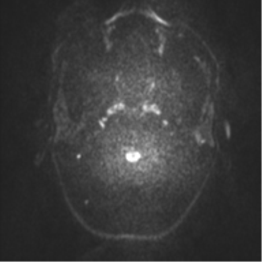 File:Anaplastic oligodendroglioma (Radiopaedia 37667-39563 Axial DWI 21).png