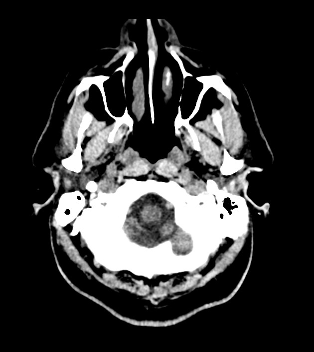 Anaplastic oligodendroglioma (Radiopaedia 79571-92758 Axial non-contrast 5).jpg