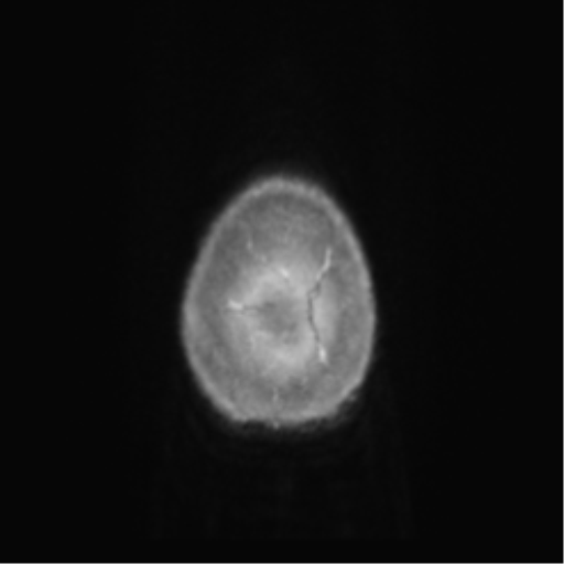 Anaplastic oligodendroglioma (Radiopaedia 83500-98599 Axial T1 C+ 77).png