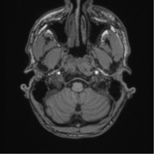 Anaplastic oligodendroglioma with skull fracture (Radiopaedia 74831-85845 Axial T1 2).png