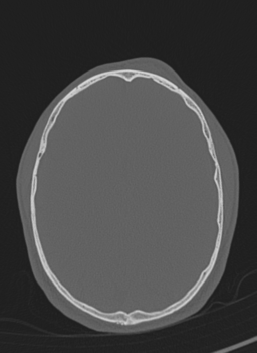 Anaplastic oligodendroglioma with skull fracture (Radiopaedia 74831-85846 Axial bone window 19).png