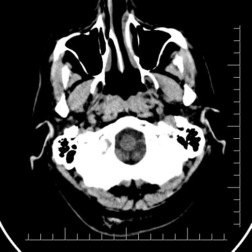 Aneurysm of posterior communicating artery (Radiopaedia 20188-20162 Axial non-contrast 4).jpg