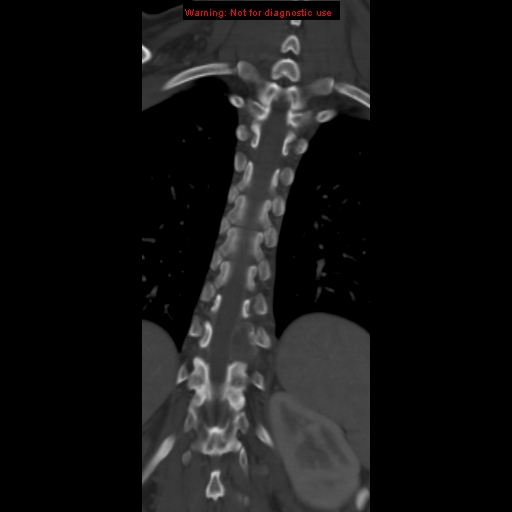 File:Aneurysmal bone cyst (Radiopaedia 9419-10102 Coronal bone window 14).jpg