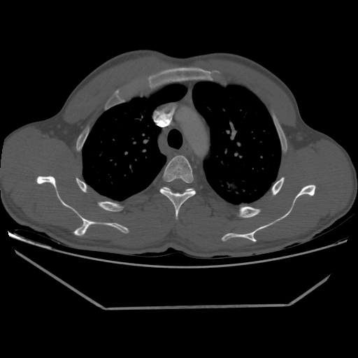 Aneurysmal bone cyst - rib (Radiopaedia 82167-96220 Axial bone window 92).jpg