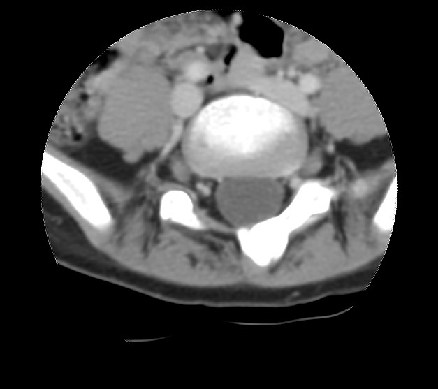 Aneurysmal bone cyst - sacrum (Radiopaedia 65190-74195 Axial non-contrast 13).jpg