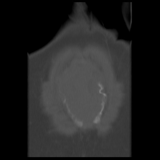 File:Aneurysmal bone cyst - sacrum (Radiopaedia 65190-74195 Coronal bone window 16).jpg