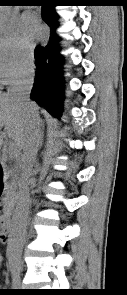 Aneurysmal bone cyst T11 (Radiopaedia 29294-29721 E 53).jpg