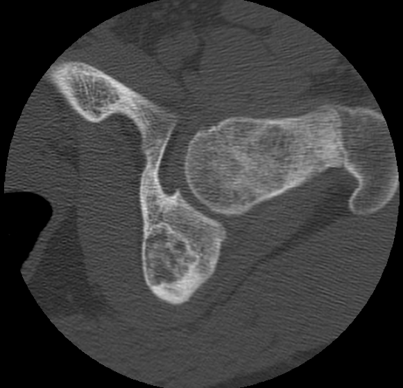Aneurysmal bone cyst of ischium (Radiopaedia 25957-26094 B 20).png