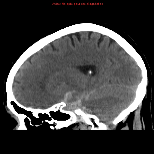 File:Aneurysmal subarachnoid hemorrhage (Radiopaedia 24740-24997 non-contrast 20).jpg