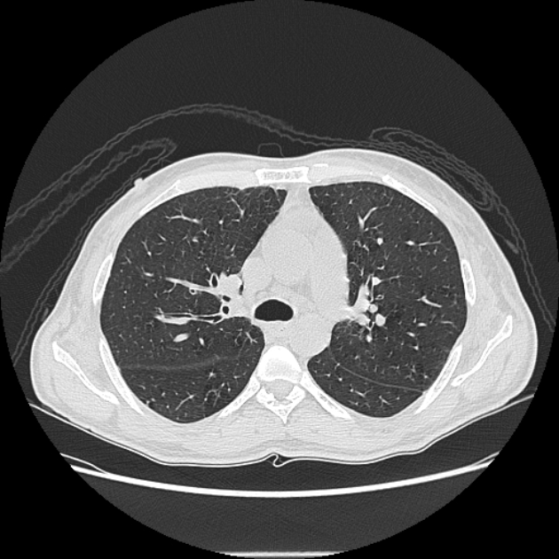 Angioinvasive aspergellosis (Radiopaedia 66995-76315 Axial lung window 19).jpg