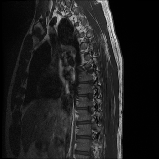 File:Angiolipoma - thoracic spine (Radiopaedia 28242-28479 Sagittal T1 12).jpg