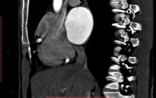 File:Anomalous left coronary artery from the pulmonary artery (ALCAPA) (Radiopaedia 70148-80181 C 69).jpg