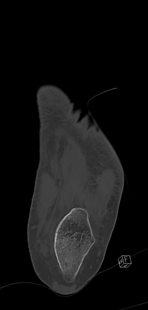 Anterior calcaneal process fracture (Radiopaedia 63353-71943 Coronal bone window 37).jpg