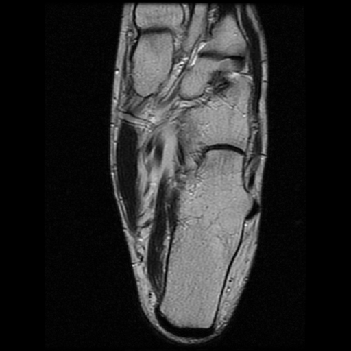 File:Anterior calcaneal process fracture (Radiopaedia 74654-85611 Axial T2 21).jpg