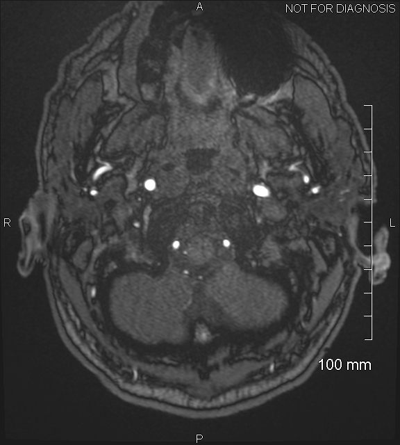 Anterior cerebral artery aneurysm (Radiopaedia 80683-94127 Axial MRA 8).jpg