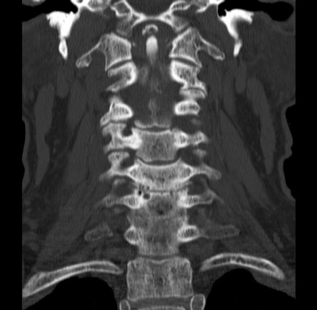Anterior cervical postdiscectomy arthrodesis (Radiopaedia 32678-33646 Coronal bone window 28).jpg