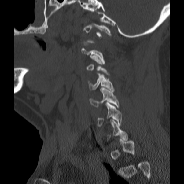 Anterior cervical postdiscectomy arthrodesis (Radiopaedia 32678-33646 Sagittal bone window 59).jpg