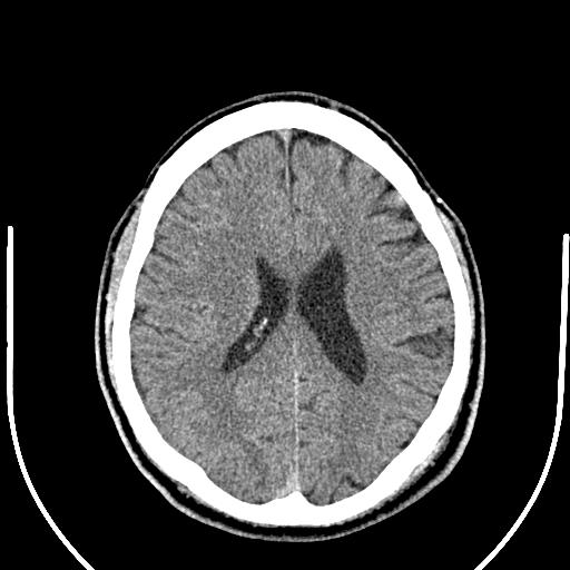 Anterior choroidal artery infarct (Radiopaedia 55106-61480 Axial non-contrast 37).jpg