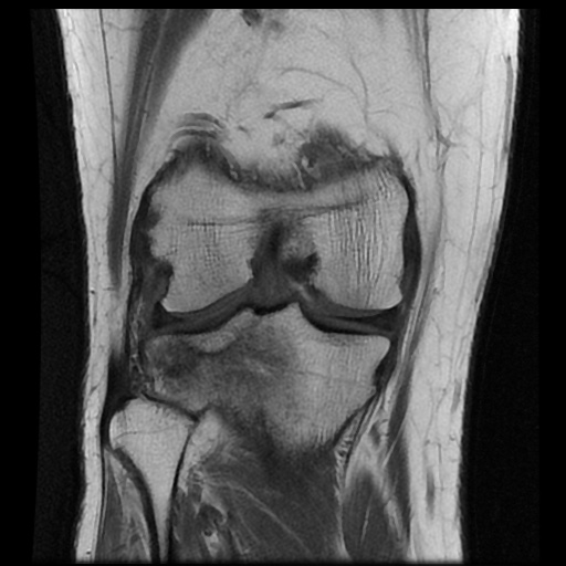 File:Anterior cruciate ligament avulsion fracture (Radiopaedia 58939-66193 Coronal T1 12).jpg