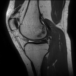 File:Anterior cruciate ligament rupture and posteromedial corner injury (Radiopaedia 67338-76723 Sagittal PD 66).jpg