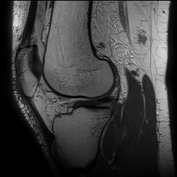 Anterior cruciate ligament rupture with Segond fracture (Radiopaedia 69043-78806 Sagittal PD 117).jpg