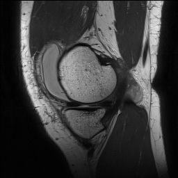 Anterior cruciate ligament rupture with Segond fracture (Radiopaedia 69043-78806 Sagittal PD 49).jpg