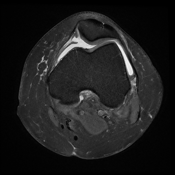 File:Anterior cruciate ligament tear, Wrisberg rip and bucket-handle tear of medial meniscus (Radiopaedia 75872-87266 Axial PD fat sat 18).jpg