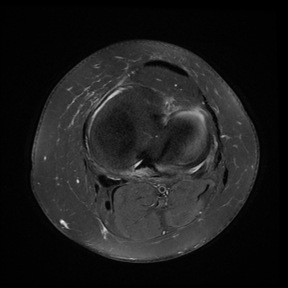 File:Anterior cruciate ligament tear, Wrisberg rip and bucket-handle tear of medial meniscus (Radiopaedia 75872-87266 Axial PD fat sat 9).jpg